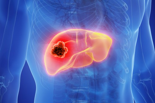 肝癌（肝臓癌）